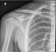Imaging Shoulder