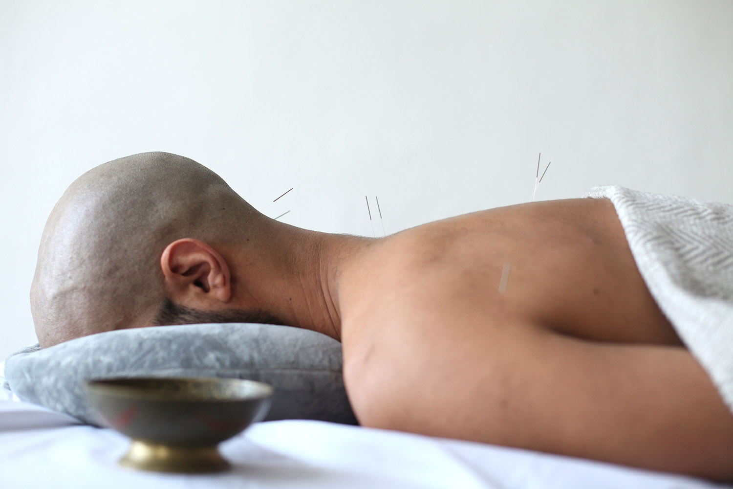 A man lies on table with acupuncture needles his body.
